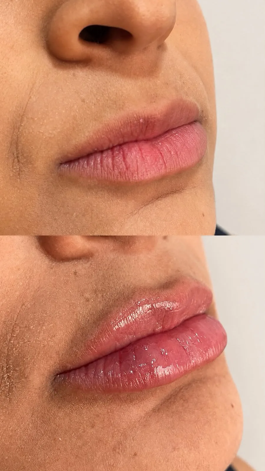 Preenchimento labial